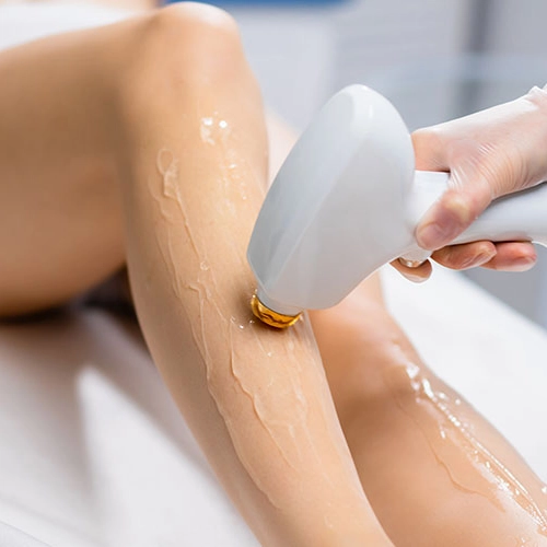 Trattamento di epilazione con laser diodo 808 nm